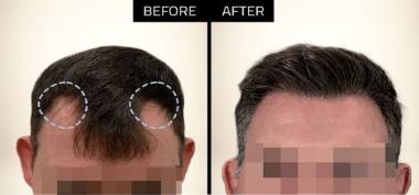 long hair transplant