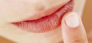 9 Cara Atasi Bibir Kering dan Pecah-pecah