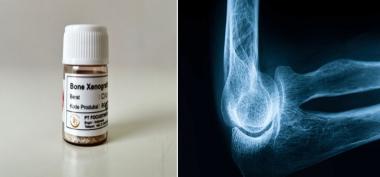 Cara Meningkatkan Kemampuan Regenerasi Tulang Pada Osteoporosis